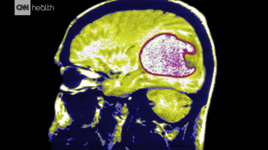 ما هو السرطان الأكثر خبثا الذي يستهدف الدماغ؟