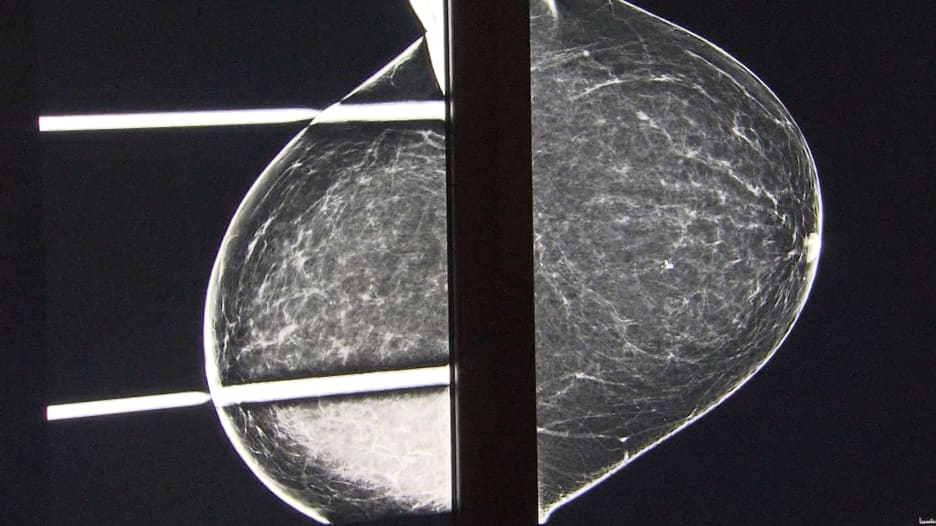 هل يقلل تصغير الثدي من خطر الإصابة بسرطان الثدي؟
