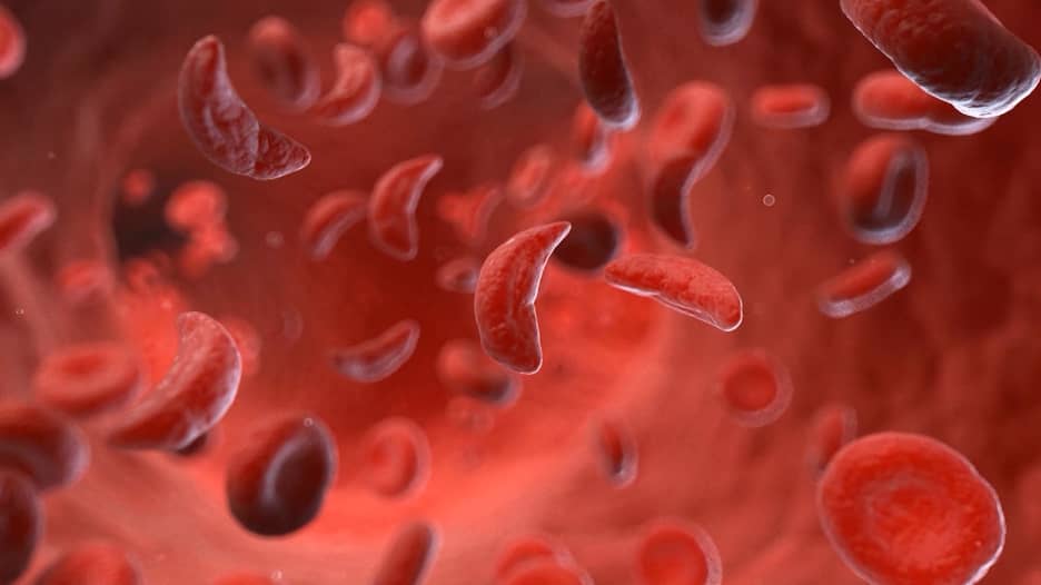 علاجان جديدان لفقر الدم المنجلي.. هل يعطيان بصيص أمل لهذا المرض الوراثي؟