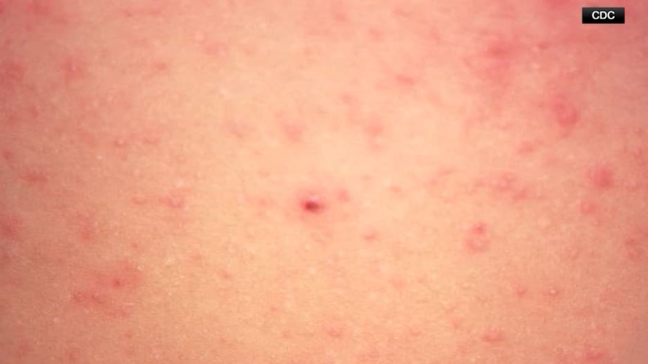 الحصبة.. مرض شديد العدوى يتفشى في أمريكا ويثير القلق