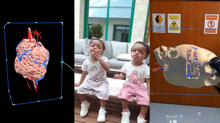 بمساعدة الذكاء الاصطناعي.. فصل توأم ملتصق في عملية جراحية معقدة استغرقت 40 ساعة