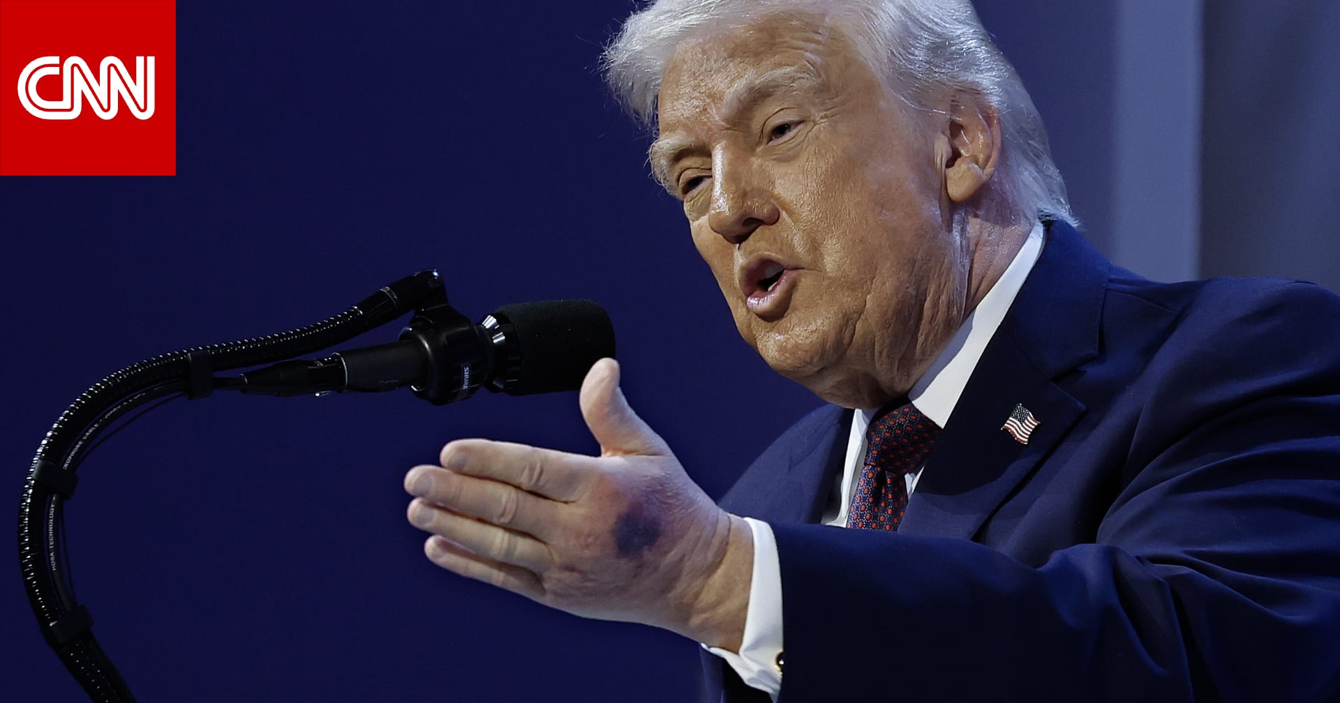 "لقد خدشتها".. ترامب يقدم "تفسيراً" لـCNN بشأن كدمة يده الكبيرة