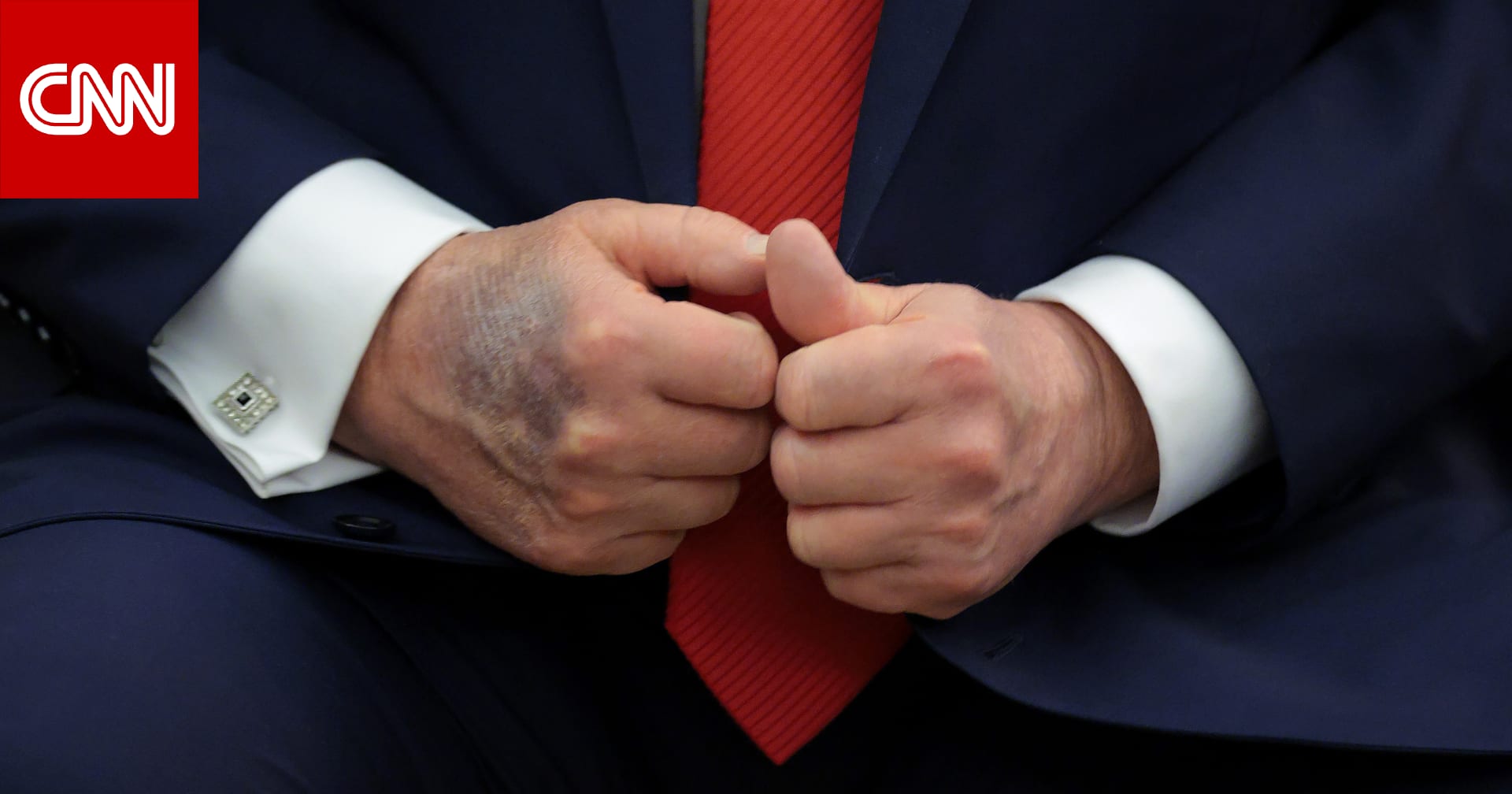 صحة ترامب.. لماذا تثير كدمات يد الرئيس الأمريكي الأكبر سناً التساؤلات؟