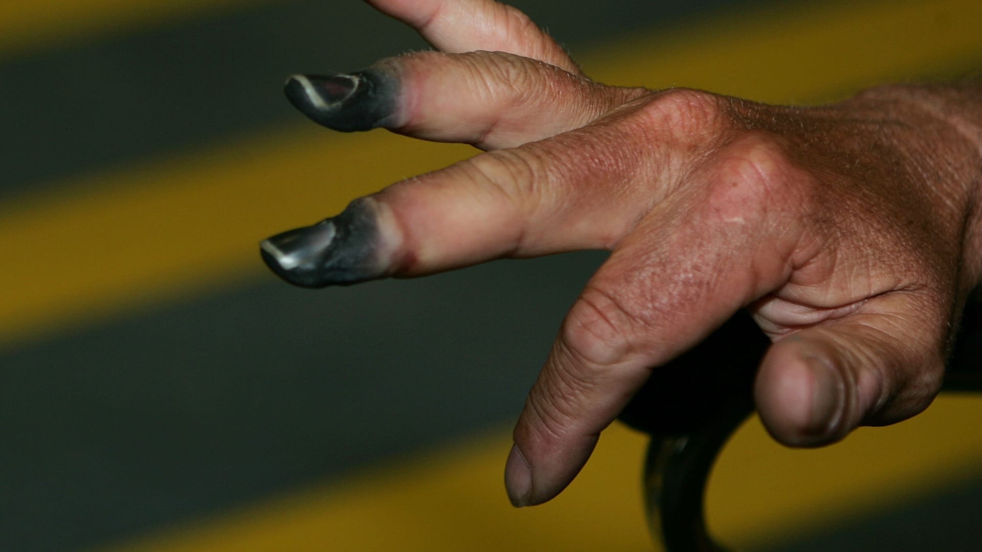 قضمة الصقيع.. ما هي وكيف تتجنبها وتعالجها؟