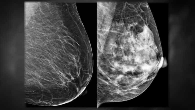 إلى جميع النساء.. هذه العلامة لسرطان الثدي قد تغفل عنها الكثيرات