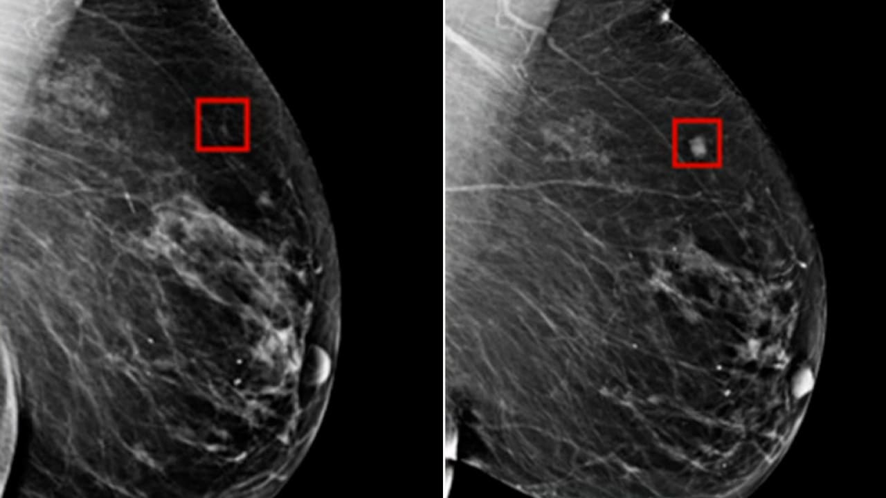 صور تظهر كيف تنبّأ ذكاء اصطناعي إصابة امرأة بالسرطان قبل 4 أعوام من إصابتها الفعلية