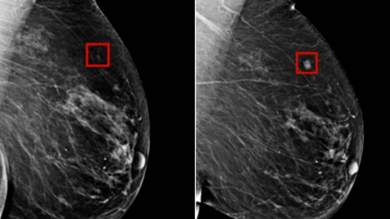 صور تظهر كيف تنبّأ ذكاء اصطناعي إصابة امرأة بالسرطان قبل 4 أعوام من إصابتها الفعلية